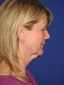 Facelift