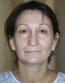 Facelift