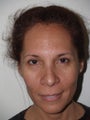 Before and just 2months after extended midfacelift and browlift