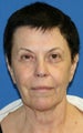 Facelift with Extended Necklift, Browlift, Fat Transfer, Upper Blepharoplasty, and Skin Pinch