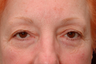 Composite facelift, midface lift, upper and lower blepharoplasty, browlift and ptosis repair