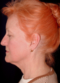 Composite facelift, midface lift, upper and lower blepharoplasty, browlift and ptosis repair