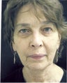 Facelift