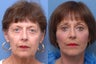 Facelift