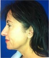Facelift