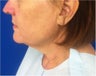 Facelift