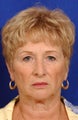 Face-necklift, Superficial cheeklift, upper blepharoplasty