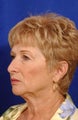 Face Lift, Neck Lift, and Upper Blepharoplasty