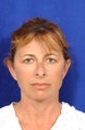 Facelift, necklift, upper blepharoplasty