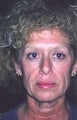 Face-neck Lift, SMAS elevation, LiveFill, Cheek Lift, and Upper Blepharoplasty