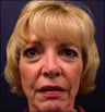 Facelift