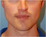 Jaw Implants for Jaw Augmentation