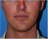 Jaw Implants for Jaw Augmentation