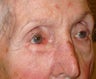 Eyelid cancer reconstruction