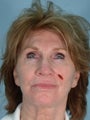 Facial Reconstruction