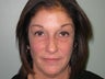 Quadbleph "eyelid lift" with midface lift, botox and juvederm to forehead