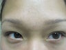 Sebaceous Hyperplasia Before & After Treatments