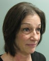 quadbleph "eyelid lift" with midface lift, botox and juvederm to forehead