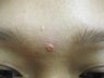 Sebaceous Hyperplasia Before & After Treatments