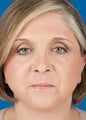 Facelift, Necklift, CO2 Laser