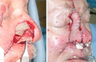 Facial Reconstruction after MOHS Surgery