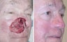 Facial Reconstruction after MOHS Surgery