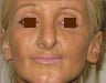Facial Micro Fat Grafting