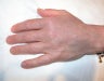 Micro Fat Grafting