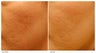 Acne Scarring Correction