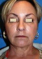YoungLift ~ Fat Transfer (Full Face)