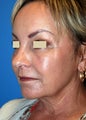 YoungLift ~ Fat Transfer (Full Face)