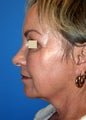 YoungLift ~ Fat Transfer (Full Face)