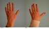 Hand Rejuvenation (with Fat Transfer)