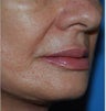 Fat Transfer / Fat Grafting / YoungVolumizer Procedure