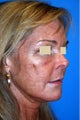 Fat Transfer / Fat Grafting / YoungVolumizer Procedure