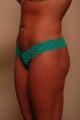 Liposuction w/ Fat to Buttocks