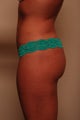 Fat Transfer