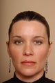 Fat Injections to Cheek & Cheekbone Area, Jawline, Brow & Lips, Botox to Brow.