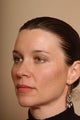 Fat Injections to Cheek & Cheekbone Area, Jawline, Brow & Lips, Botox to Brow.