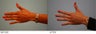 Hand Fat Transfer