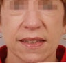 Fat Transfer to Face