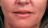 Lip Augmentation