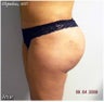Brazilian Butt Lift