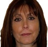 Facial Fat Injections