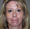 Fat injections and Laser Resurfacing