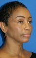Fat Transfer and Lower Eyelid Skin Pinch