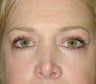 Fat transfer and Skin resurfacing