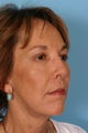 Fat transfer with facelift, eyelid surgery and brow lift