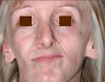 Facial Micro Fat Grafting