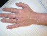 Micro Fat Grafting